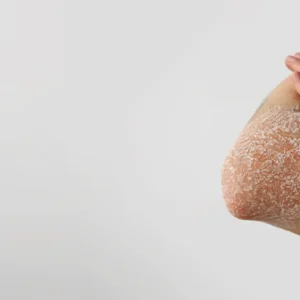 Prescrição Online para Tratamento da Psoríase – Rápido e Eficaz