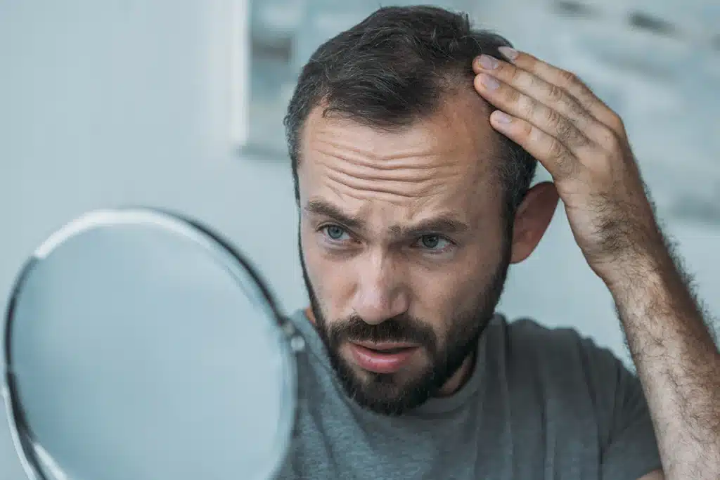 Tratamentos para Calvície Masculina