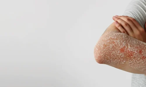 Prescrição Online para Tratamento da Psoríase – Rápido e Eficaz